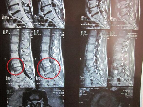 Diagnóstico de osteocondrosis cervical