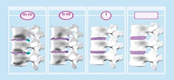 Etapas de la osteocondrosis cervical