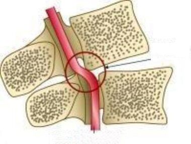 Síndrome de la arteria Vail