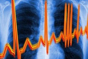arritmia cardíaca para la osteocondrosis