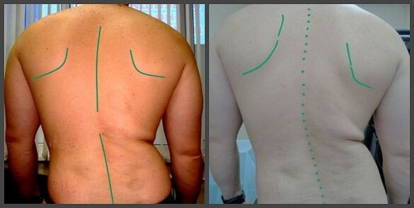 curvatura de la columna con osteocondrosis