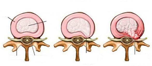 hernia intervertebral con osteocondrosis cervical