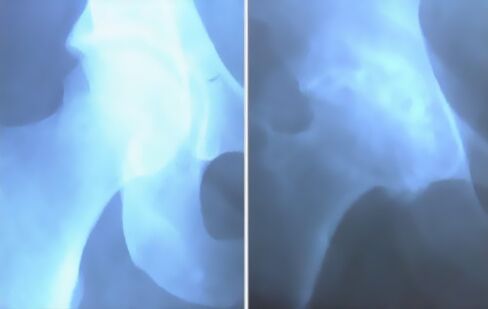 Escoria de artrosis de la articulación de la rodilla