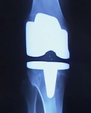X -Ray de la rodilla con una prótesis artificial después de la operación para cambiar la articulación